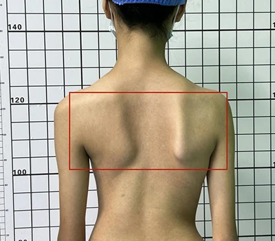 Penilaian Skoliosis Komprehensif: Memahami, Mengidentifikasi, dan Mengatasi Kesehatan Tulang Bela...