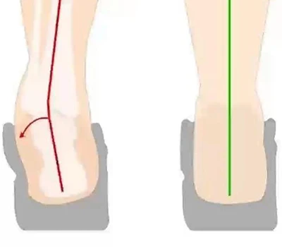 Penilaian Heel Everversion dan Heel Inversion: Evaluasi Klinis, Aplikasi Praktis, dan Integrasi K...