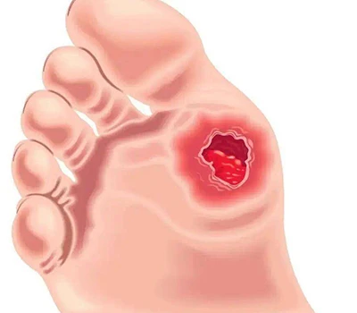Penilaian Kaki Diabetik: Wawasan Klinis, Manajemen Risiko, dan Peluang Komersial