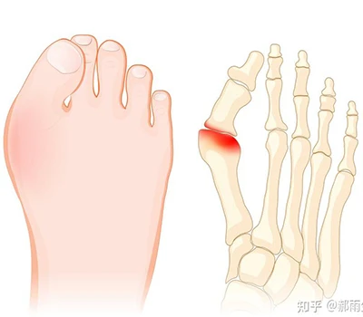 Hallux Valgus: Panduan Sains Lengkap