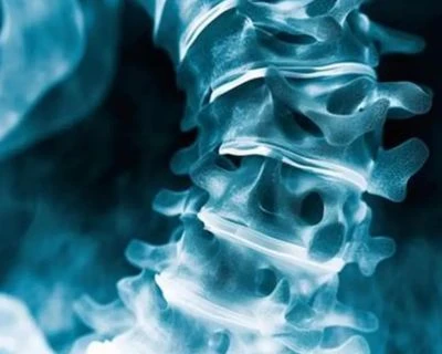 Pemeriksaan Skoliosis AI dan Pelacakan Keselarasan Tulang Belakang: Solusi Pemeriksaan Kesehatan ...