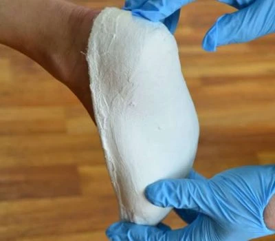 Bagaimana Pemindai Kaki 3D Akan Mengubah Masa Depan Perangkat Pendukung Ortopedi?