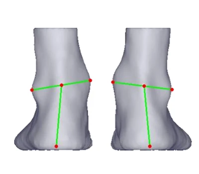 HEEL VALGUS DAN VARUS: Ancaman diam -diam