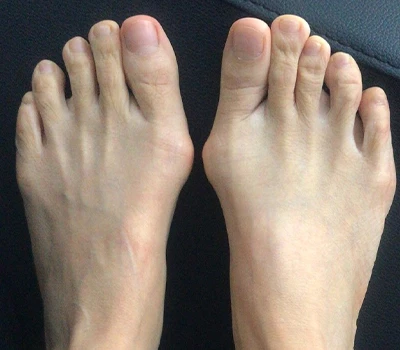 Pengukuran Hallux Valgus: Mengapa Pemindai 3D melampaui dokter dan rumah sakit