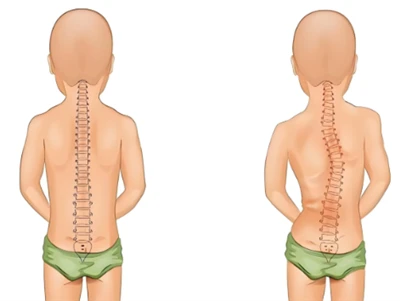Metode Pemeriksaan Skoliosis Baru: Tulang Belakang Digital AI & 3D