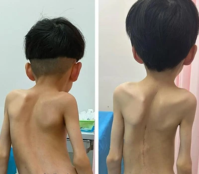 Kesehatan Tulang Belakang: Peran Teknologi Pemindaian Tubuh 3D dalam Penilaian Skoliosis dan Tran...