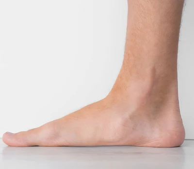 The Silent Epidemic: Memahami Kaki Datar dan Solusi Teknologi untuk Tantangan Kesehatan Kaki Global