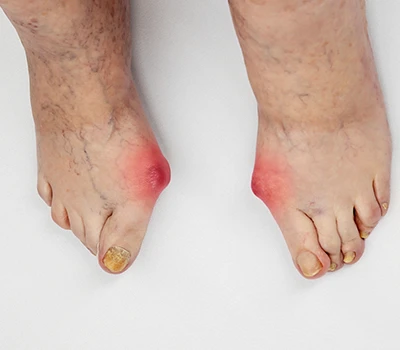 Pencegahan Kaki Diabetik – Bagaimana Pemindaian 3D Memungkinkan Intervensi Dini dalam Layanan Kes...